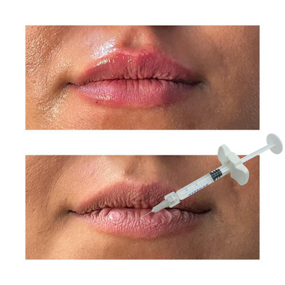 비 외과적 Lip 향상 충전기 히알루론산 Lip 주입