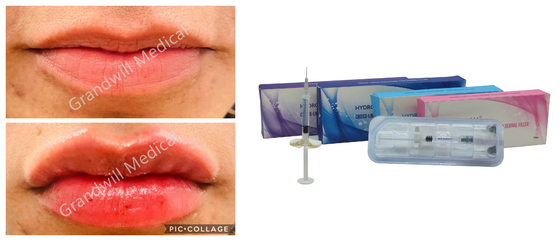 Lip 충분함 안면 주름을 위한 교차하는 연결된 소디움 히알루로닉산 주입 피부 필러