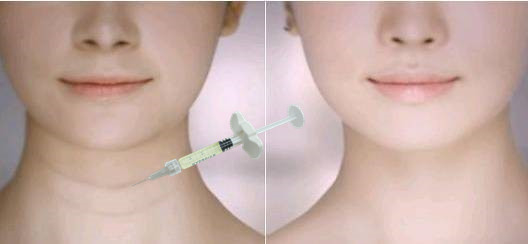 피부 립 필러로 펌퍼 립을 얻으십시오 목 라인 얼굴 주름을 채우는 필러