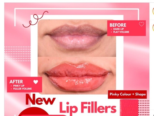 HYDROIAM Kiss with B12 Ha Filler Red Lips Filler Hyaluronic Acid Filler 자연스러운 부피와 색을 제공합니다