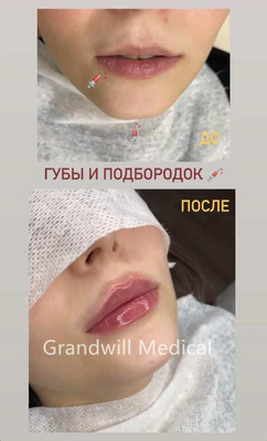 24mg/ml 주사용 히알루론산 피부 필러