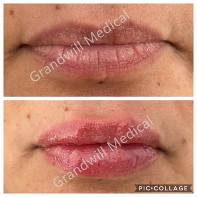 입술 확대술 주사 가능한 히알루론산 젤 피부 필러 1ml 2ml