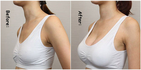 히알루론산 유방 주입 충전물 유방 나트륨 히알루로네이트 증진 젤