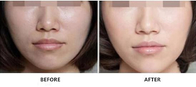 얼굴 노화 방지를 밝게 하는 피부를 위한 2ml 2.5ml 비 교차 연결 HA 피부 충전물