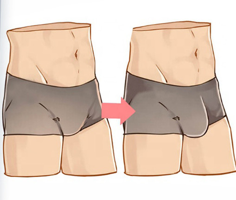 음경 확대를 위한 히알루론산 나트륨 하 필러 주사