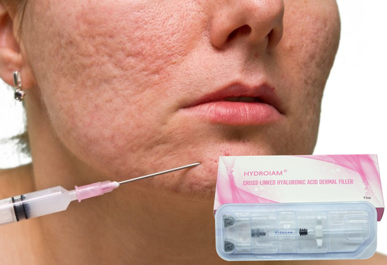 미세한 얼굴 주름 제거를 위한 1ml 히알루론산 나트륨 젤 주입
