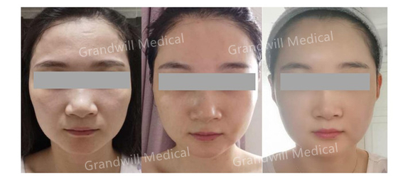 히알루론산 PCL 피부 부스터 기적적 터치 업 피부 교원질 자극물질