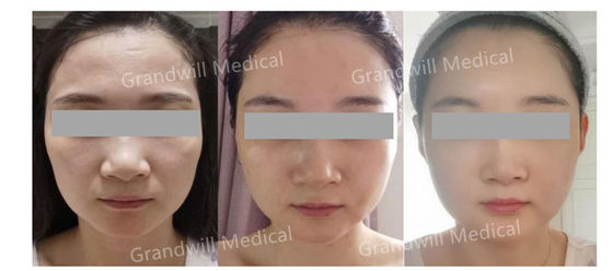 비생태성 십자 연결 히알루론산 피부 필러 자연스러운 외모 얼굴 외형 및 피부 재생을 위해 설계
